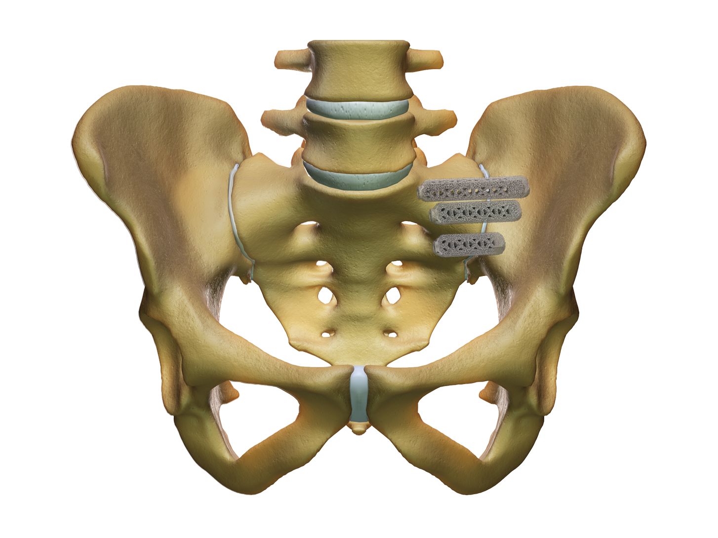 Si Joint Surgery The Ifuse Implant System Si Bone