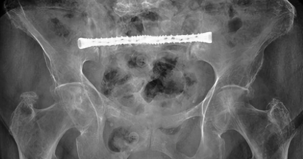 Pelvic Insufficiency Fracture | SI-BONE