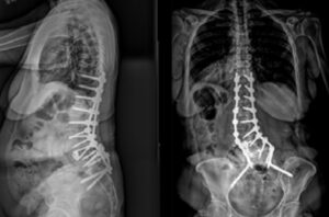 Eastlack - Deformity Revision - 2