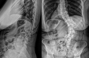 Eastlack - Adult Scoliosis - 1
