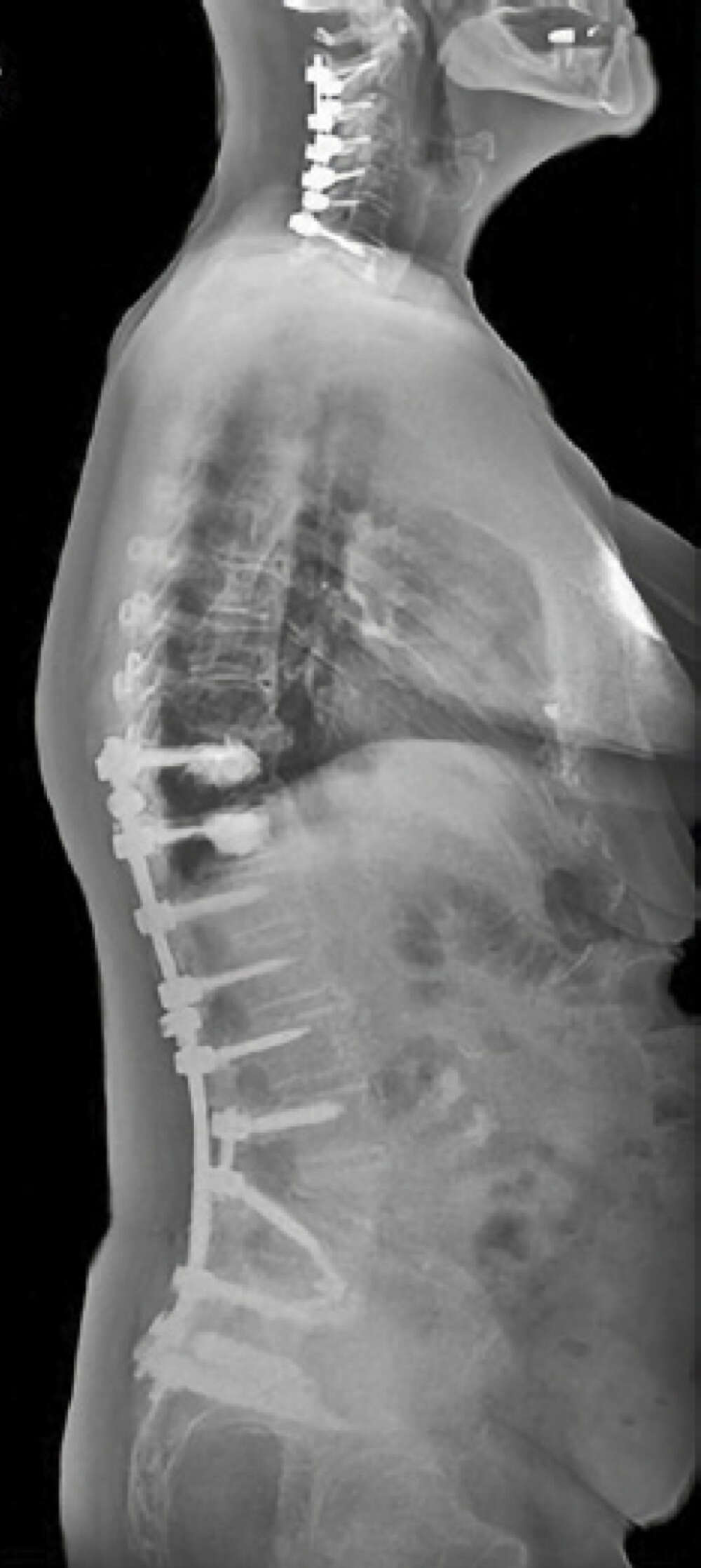 Turner - Sagittal Plane Deformity - 3