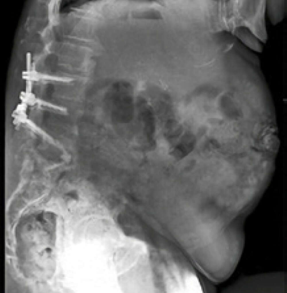 Turner - Sagittal Plane Deformity - 1