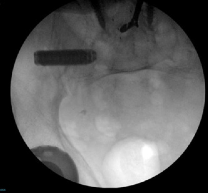 Boone - MIS SI joint fusion - 2