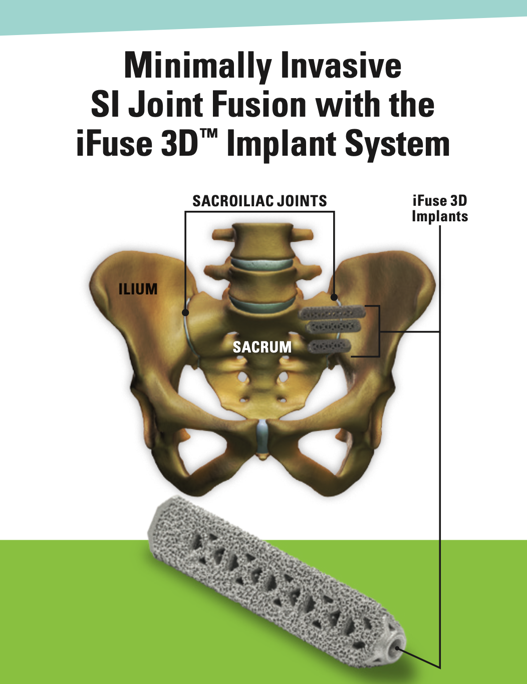 iFuse 3D Brochure