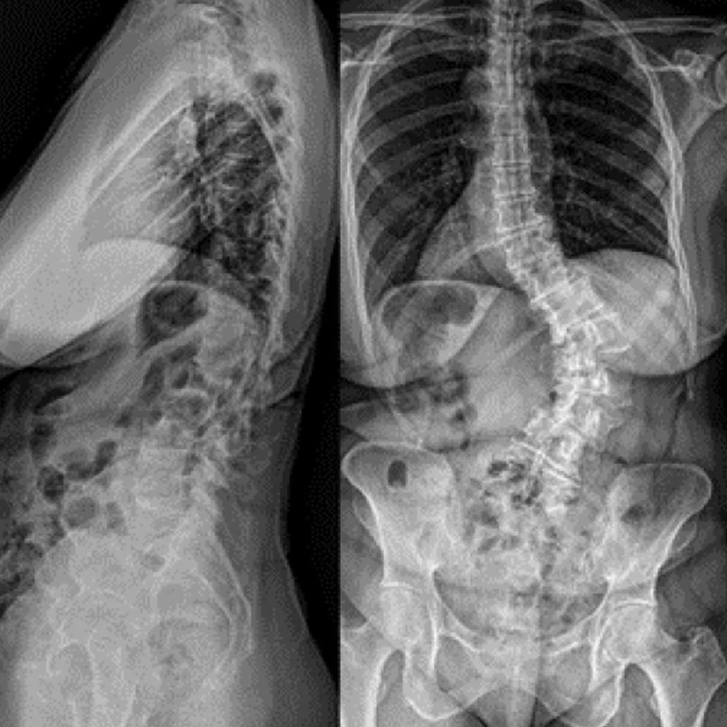 Eastlack - Adult Scoliosis - 1