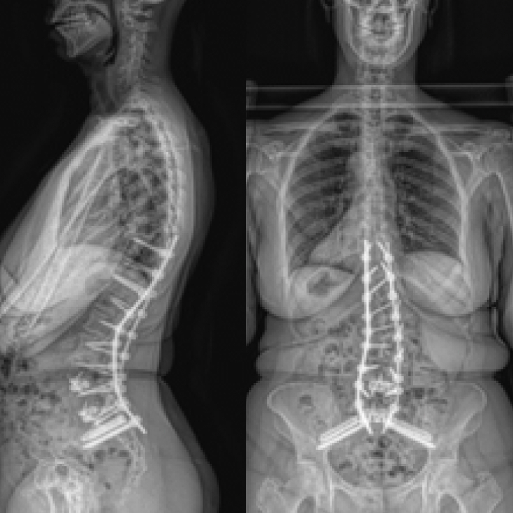 Eastlack - Adult Scoliosis - 2