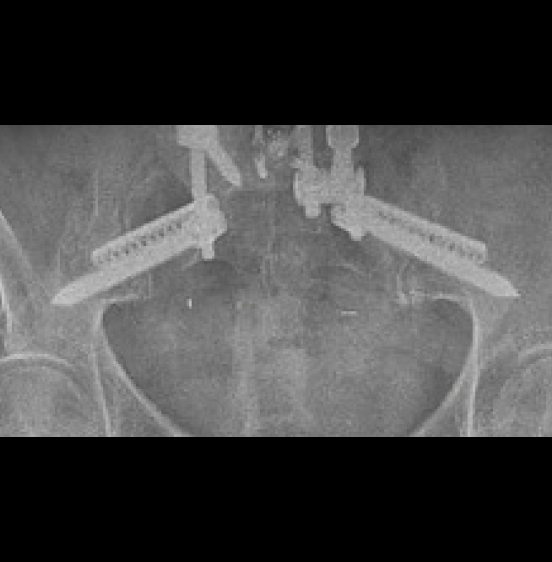 Turner - Sagittal Plane Deformity - 2